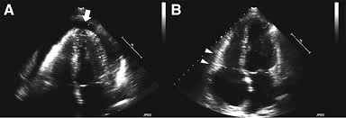 Image result for Pericarditis