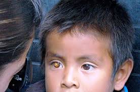 Niños en edad escolar podrían tener bajo rendimiento por problemas de  visión