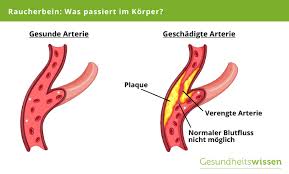 Raucherbein Ursachen Risikofaktoren Behandlung