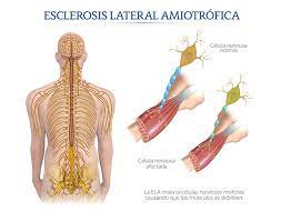 Española ela, asociación de esclerosis lateral amiotrófica de ca и esclerosis lateral amiotrófica. Medica Sur Esclerosis Lateral Amiotrofica