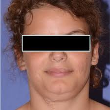 PDF) Oral sialadenoma papilliferum with kras mutation in a patient with  linear nevus sebaceous syndrome