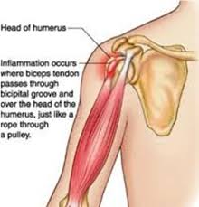 Thickening or calcium deposits in the supraspinatus tendon or subacromial bursitis results in pain during abduction of shoulder joint. Biceps Tendinitis Brisbane Knee And Shoulder Clinic Dr Macgroartybrisbane Knee And Shoulder Clinic
