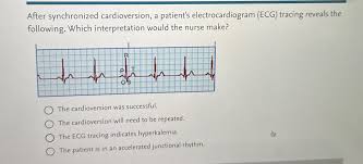 Image result for Synchronized Cardioversion