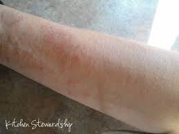 Candida Symptoms Naturopath Vs M D About The Surprise Rash