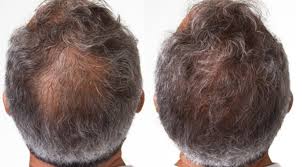 This is by increasing the blood supply to the follicle and is thought to even make the hair shaft thicker. Hair Loss Treatment Lehi Prp Therapy Saratoga Springs