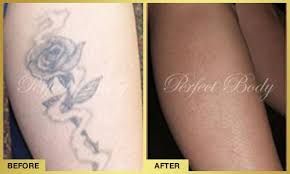 Oregon tattoo removal is located at 911 main st ste 100 in oregon city and has been in the business of tattoo parlor since 2010. Tattoo Removal Gallery Perfect Body Laser Aesthetics Long Island Ny