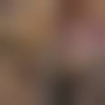 Image result for Pyoderma Gangrenosum