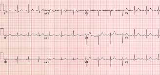 Normal Ecg Queen Eck Practice Normal Ecg Ecg Interpretation Studying Medicine