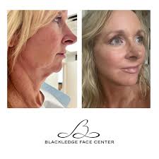 Blackledge Face Center