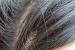 Lice In Hair Vs Dandruff