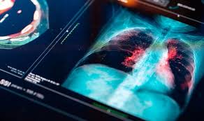 Lung cancer signs and symptoms. Lung Cancer Symptoms All 14 Most Common Signs Of Lung Cancer Full List Vighneshworld Com