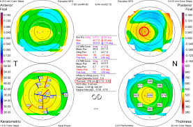 (learn more) some types of surgery are more sophisticated and come with higher costs. Is Wavefront Lasik Worth It