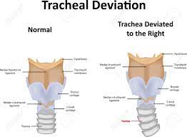 Tracheal Deviation Illustration Royalty Free SVG, Cliparts, Vectors, and  Stock Illustration. Image 43562227.
