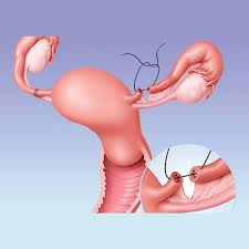 Medical illustration of fallopian tube surgery on the female reproductive system