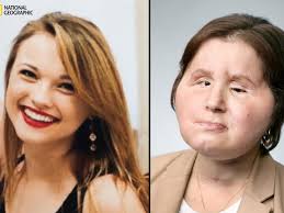 Transplantation: Katie verliert ihr Gesicht