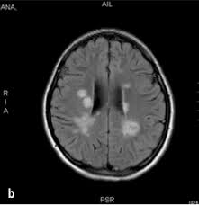 Multiple sclerosis (ms) causes, signs and general information at patient.info. Http Revecuatneurol Com Wp Content Uploads 2018 03 Desmielinizacion Del Sistema Nervioso Pdf