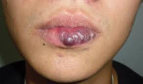 Cherry angioma marks can be removed with cryotherapy, a procedure that uses extreme cold to destroy unwanted tissue. A Rare Case Of Tongue And Lip Hemangioma In An Adult Patient Springerlink