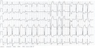 Image result for Extrasystole