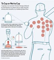 The Mets And Our Own Oakland A S Are Using The Chinese Therapy Of Cupping Nick Paparesta The Trai Biologicheski Aktivnye Tochki Igloukalyvanie Akupressura