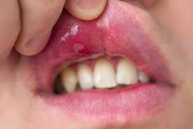 Image result for Canker sores symptoms roof of the mouth