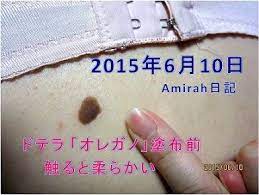 ドテラ オレガノ で背中のイボが取れた 脂漏性角化症 老人性疣贅 ドテラ エッセンシャルオイル ベリーダンサー amirah 埼玉県ふじみ野市 川越市 ベリーダンサー ドテラ ベリー