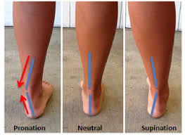 Pronation And Overpronation For Walking And Running Pronation Overpronation Kinesiology Taping