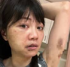 高嘉瑜遭男友施暴分辨恐怖情人「7大特徵」：快跑│TVBS新聞網