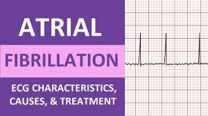 Image result for Atrial Fibrillation