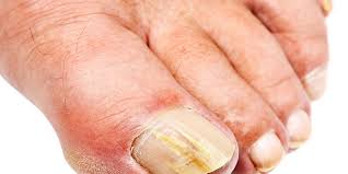 Surgical nail removal may be recommended in. What Causes Toenail Fungus How To Prevent Onychomycosis Or Crusty Yellow Nails Men S Health