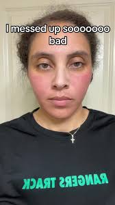 Se Pone El Rostro Rojo Su Uso Tretinoina