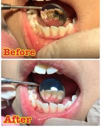 Oleh itu, janganlah kita beranggapan negatif terhadap orang yang memakai pendakap gigi. Klinik Pergigian Dr Smile Taman Melawati Dentist In Taman Melawati