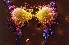 For some, treatment may never be learn as much as you need to know about your cancer and its treatment in order to understand what. A Better Prostate Cancer Test Wsj