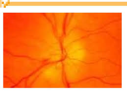 It is believed that the body's normal drop in blood pressure during sleep ― along with one or more underlying risk factors ― triggers an interruption of blood flow to the optic nerve. Anterior Ischemic Optic Neuropathy Aion Most Common Over