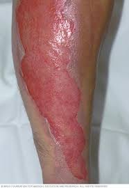 Any blistering shows signs of second degree burn. Burns Symptoms And Causes Mayo Clinic