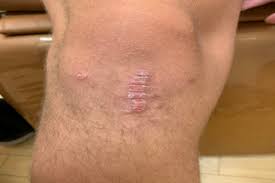 Image result for koebner phenomenon psoriasis