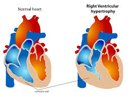 Right Ventricular Hypertrophy Wikipedia