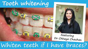 The easiest way to whiten your teeth is to prevent stains and yellowness from. Can You Have Teeth Whitening With Braces On Youtube