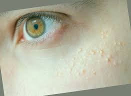 One drawback is that your. Acne After Stopping Birth Control How To Treat It Can Birth Control Pills Actually Help Acne Spacedoutinc Org