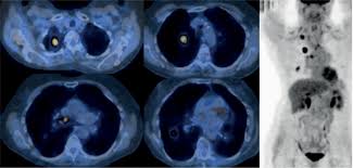 Lung cancer is the leading cause of cancer deaths among adults in the united states. Scielo Brasil Pet Ct Imaging In Lung Cancer Indications And Findings Pet Ct Imaging In Lung Cancer Indications And Findings