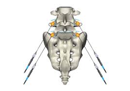 Image result for Radiofrequency Surgery