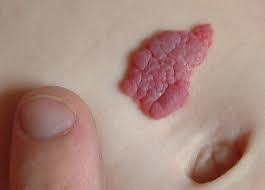 Cherry angiomas are small, red, skin growths made up of small blood vessels. Identifying 21 Common Red Spots On Skin Universal Dermatology