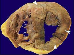 Acute Kidney Injury And Cardiac Arrhythmia As The Presenting Features Of Widespread Diffuse Large B Cell Lymphoma