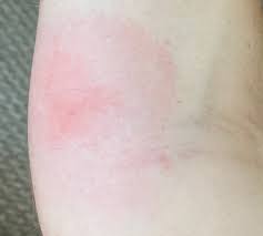 Image result for Fire Ant Sting