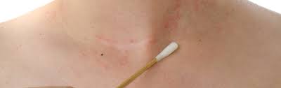 Atopic eczema is a chronic inflammatory skin disease characterized by skin barrier disruption, inflammation and dysbiosis. Atopisches Ekzem Gesunde Hautflora Schutzt Vor Neurodermitis Spektrum Der Wissenschaft
