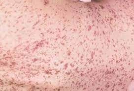 A concise review with a comprehensive summary of therapeutic interventions emphasizing supportive measures.advther. Typical Pattern Of Stevens Johnson Syndrome Blisters Develop On Download Scientific Diagram