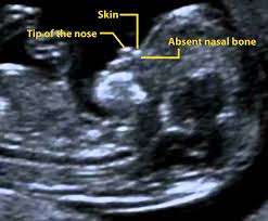 Nuchal translucency ultrasound alone can also provide this risk assessment, but it is not as accurate as combined first trimester screening. Nasal Bone Fmf Certification Welcome To The Fetal Medicine Foundation