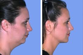 Corrective Jaw Surgery Facial And Neck Liposuction