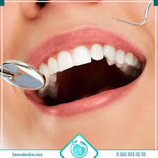 Komple diş yaptırmak halk arasında diş taktırma fiyatları diş taktırma kişinin ağız yapısına uygun olan damak ve diş protezinin takılmasıdır. Gulus Tasarimi Nedir Gulus Estetigi Fiyatlari Ve Bilmeniz Gerekenler Keskin Dis Klinigi