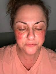 Howdy All.....I suffer from Inverse P and I am currently fighting with it  in my booty crack (I don't give a hoot who see's my post, Inverse P is no  joke)........Open sores,