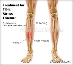 Image result for stress fracture free images. Diagram anatomically identifying the bones involved in a Stress Fracture of the leg, knee, ankle and foot.